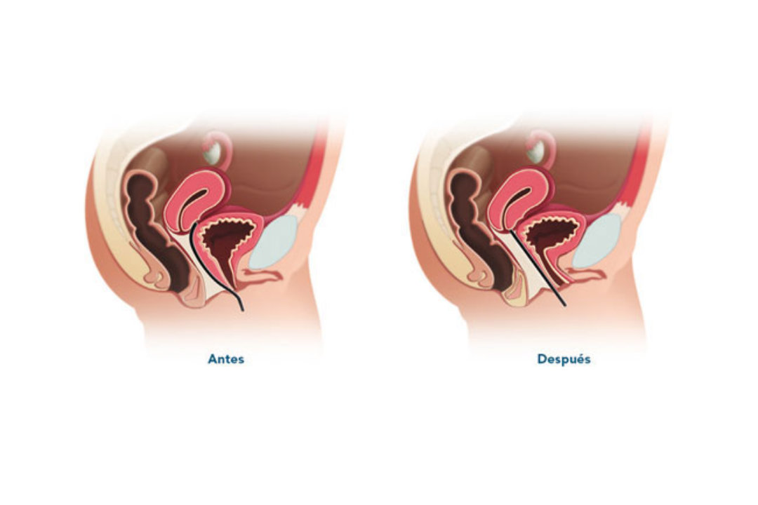 Dra. Silvia Villagrán, Ginecología, Control Ginecológico, Anticoncepción, Climaterio Y Post Menopausia, Control Mamario, Detección De Cáncer Cervical, Ginecoestética, Labioplastía De Reducción, Labioplastia De Aumento, Rejuvenecimiento Con Radiofrecuencia, Aumento Del Punto G, Rejuvenecimiento Vaginal, Atrofia O Resequedad Vulvovaginal, Vaginoplastia, Incontinencia De Esfuerzo, Colposcopía, Patología Vulvar, Obstetricia, Control Prenatal, Quito, Ecuador, www.doctorasilviavillagran.com